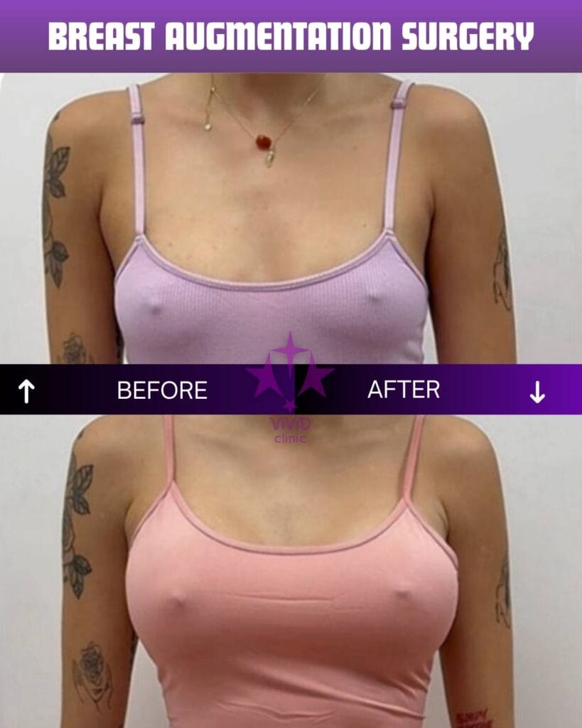 Before and after breast augmentation surgeon performed at Vivid Clinic