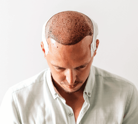 زراعة الشعر قارن بين خيارات زراعة الشعر في إسطنبول، بما في ذلك زراعة الشعر بتقنية FUE، وDHI، وزراعة اللحية، وتخطيط زراعة الشعر للنساء في عيادة فيفيد.