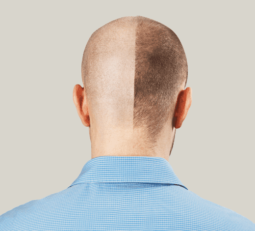 زراعة الشعر قارن بين خيارات زراعة الشعر في إسطنبول، بما في ذلك زراعة الشعر بتقنية FUE، وDHI، وزراعة اللحية، وتخطيط زراعة الشعر للنساء في عيادة فيفيد.