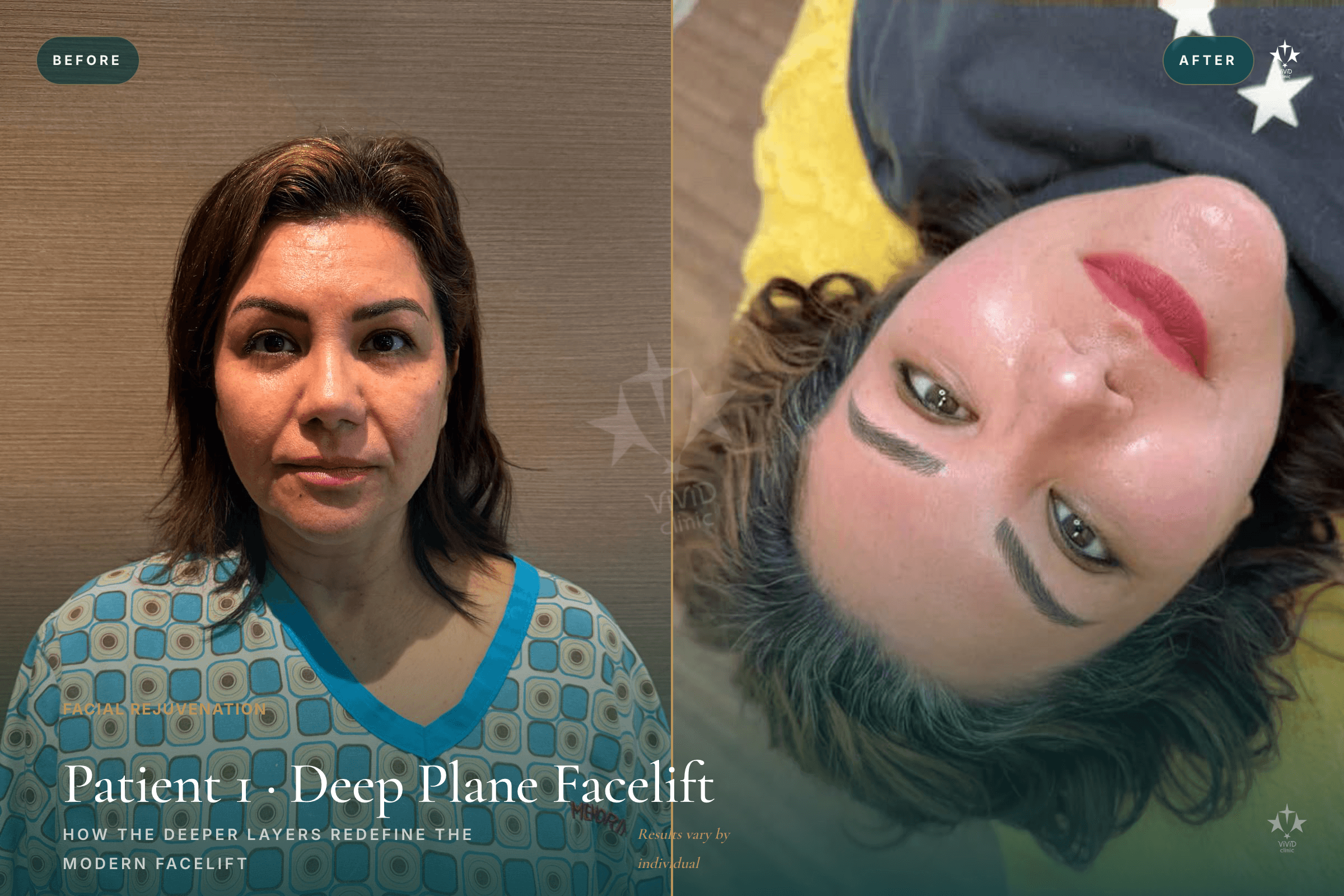 vivid-blog-deep-plane-facelift-04-before-after-split-1200-800