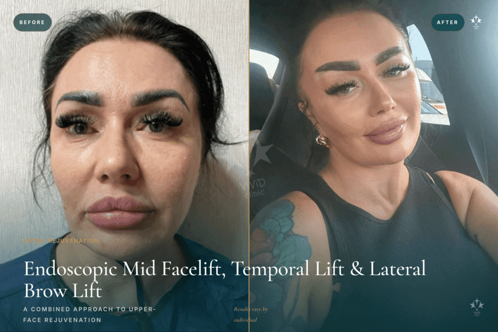 Fox Eye Lift and Canthal Tilt: The Cat-Eye Look Explained Endoscopic mid facelift, temporal lift and lateral brow lift before and after at Vivid Clinic Istanbul