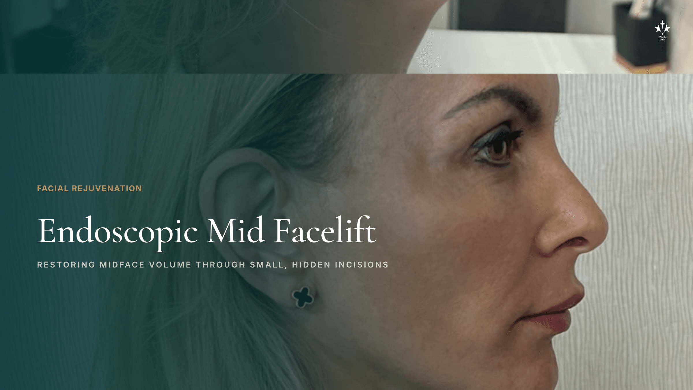 Endoscopic mid facelift before and after of a Vivid Clinic patient. Side view.