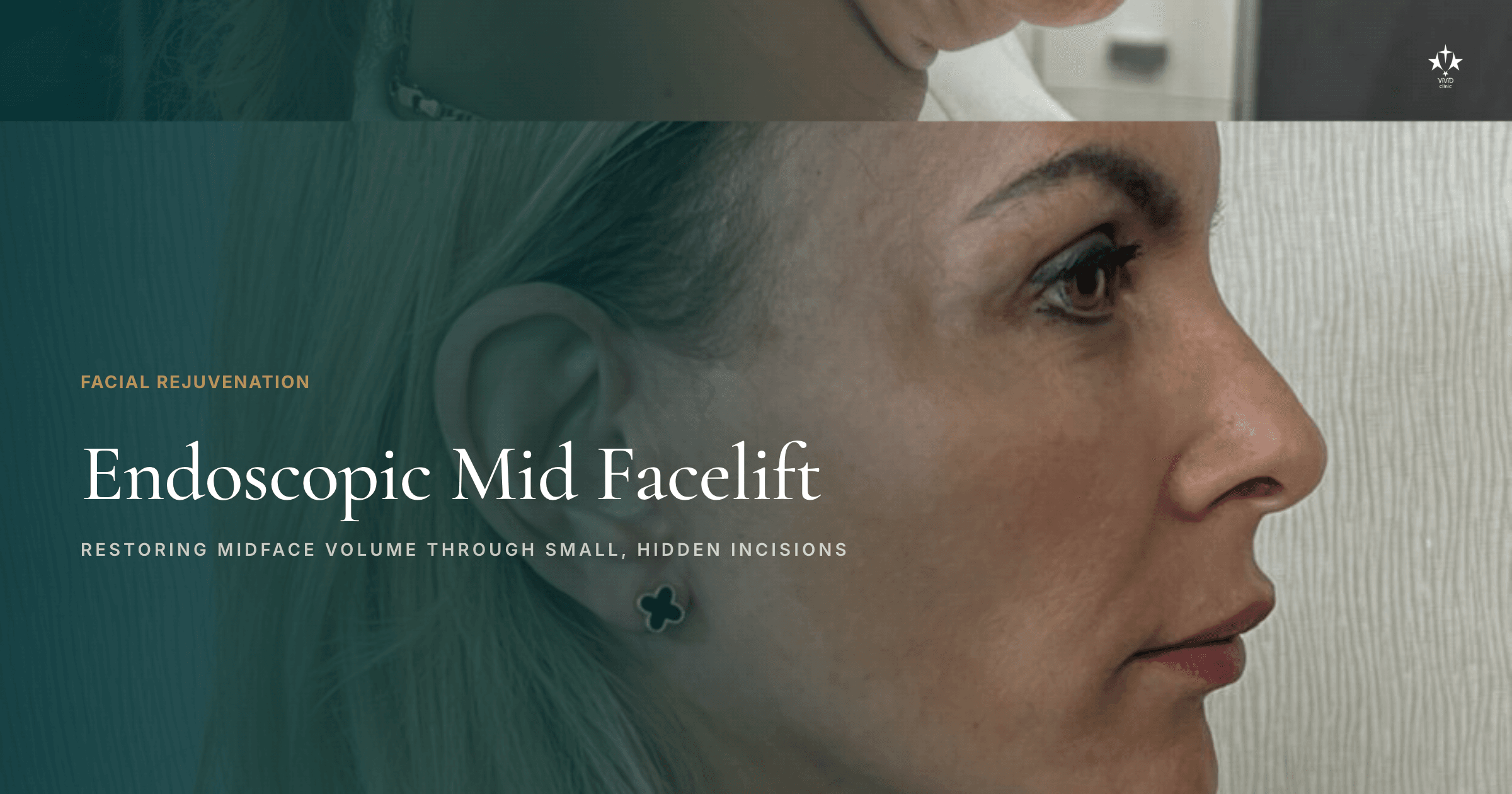 Endoscopische mid-facelift Istanbul sociale deelkaart
