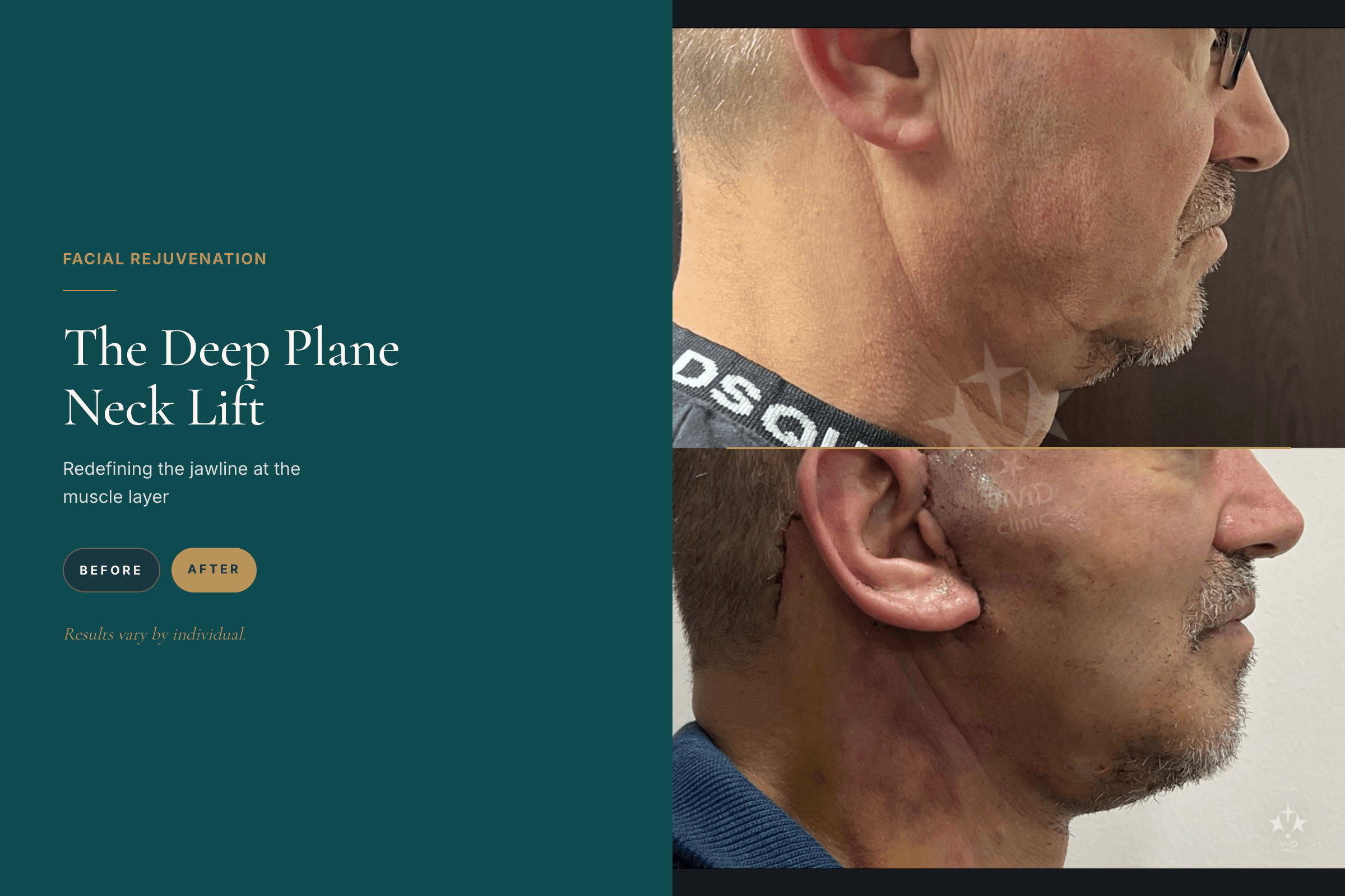 De diepe halslift — het herdefiniëren van de kaaklijn op spierniveau. Patiënt 3, diepe halslift voor en na (collage) bij Vivid Clinic Istanbul.
