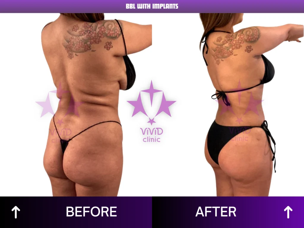 Natural BBL Surgery in Istanbul: Everything You Need to Know Rear-oblique before and after comparison of BBL with implants at Vivid Clinic in Turkey