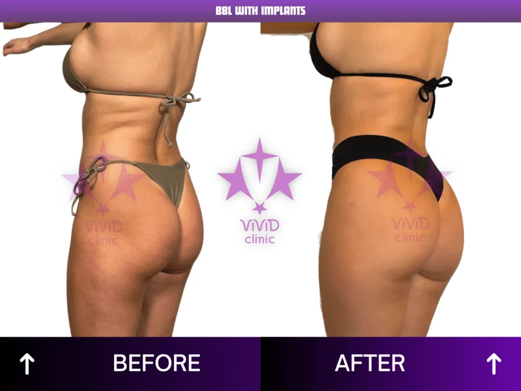 Natural BBL Surgery in Istanbul: Everything You Need to Know Rear-oblique before and after comparison of BBL with implants at Vivid Clinic in Turkey