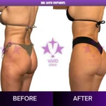 Brazilian Butt Lift Turkey: 8 Trusted Insights Before Your Transformation Rear-oblique before and after comparison of BBL with implants at Vivid Clinic in Turkey