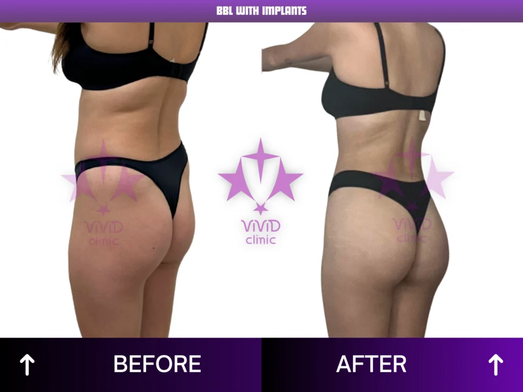 Natural BBL Surgery in Istanbul: Everything You Need to Know Rear-oblique before and after comparison of BBL with implants at Vivid Clinic in Turkey