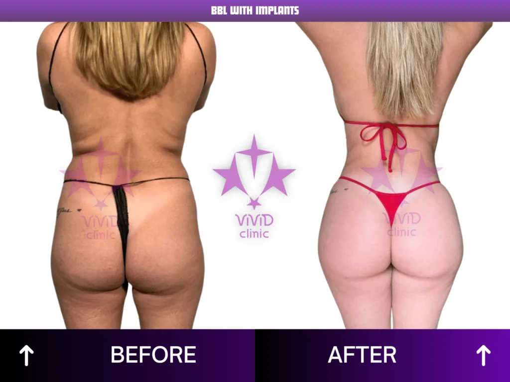 Natural BBL Surgery in Istanbul: Everything You Need to Know BBL With Implants Before and After – Rear View 04 | Vivid Clinic