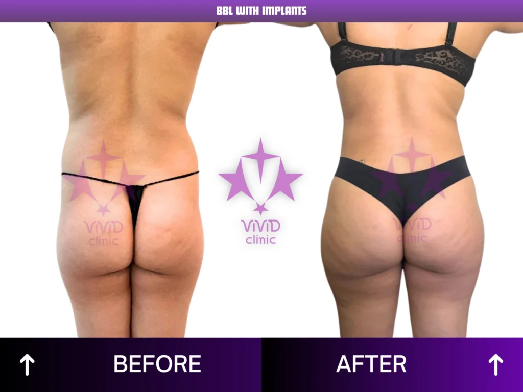 Natural BBL Surgery in Istanbul: Everything You Need to Know Rear-view before and after comparison of BBL with implants at Vivid Clinic in Turkey