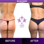 Brazilian Butt Lift Turkey: 8 Trusted Insights Before Your Transformation Rear-view before and after comparison of BBL with implants at Vivid Clinic in Turkey