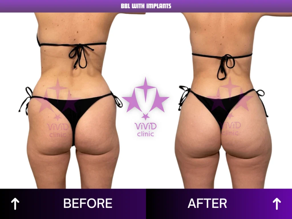 Natural BBL Surgery in Istanbul: Everything You Need to Know Rear-view before and after comparison of BBL with implants at Vivid Clinic in Turkey