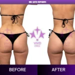 Brazilian Butt Lift Turkey: 8 Trusted Insights Before Your Transformation Rear-view before and after comparison of BBL with implants at Vivid Clinic in Turkey