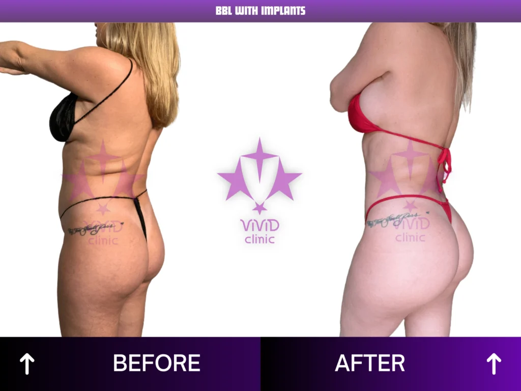 Natural BBL Surgery in Istanbul: Everything You Need to Know BBL With Implants Before and After – Side View 01 | Vivid Clinic