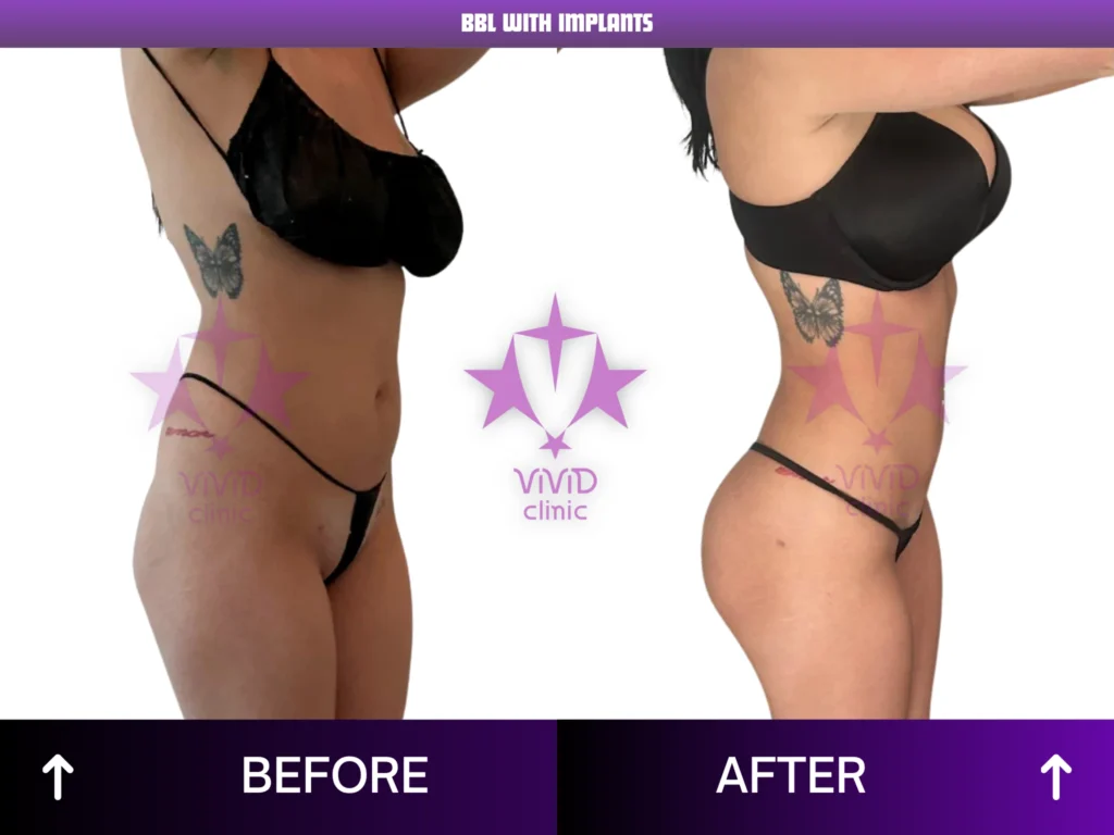 Natural BBL Surgery in Istanbul: Everything You Need to Know BBL With Implants Before and After – Side View 08 | Vivid Clinic