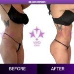 تكلفة بي بي إل في تركيا: 5 عوامل خبراء تحدد السعر BBL With Implants Before and After – Side View 08 | Vivid Clinic