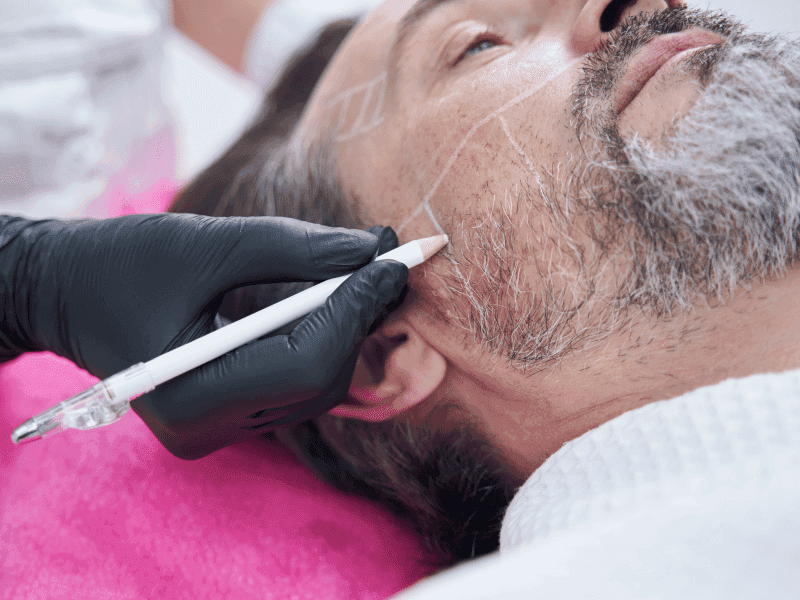 Baardtransplantatie in Turkije: 6 praktische tips vóór uw transformatie Persoonlijk adviesgesprek voor een baardtransplantatie