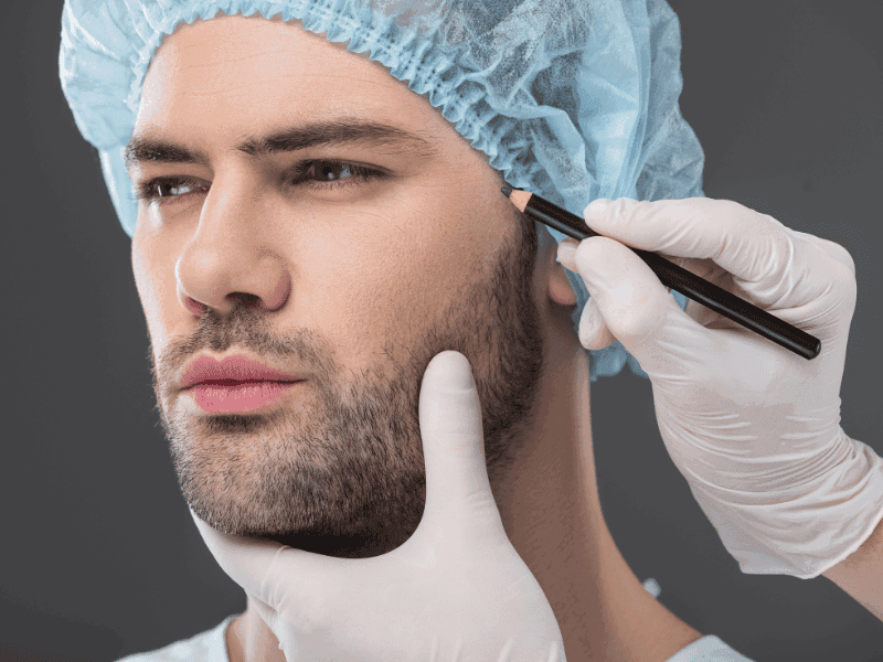 Baardtransplantatie in Turkije: 6 praktische tips vóór uw transformatie De voordelen van een baardtransplantatie afwegen