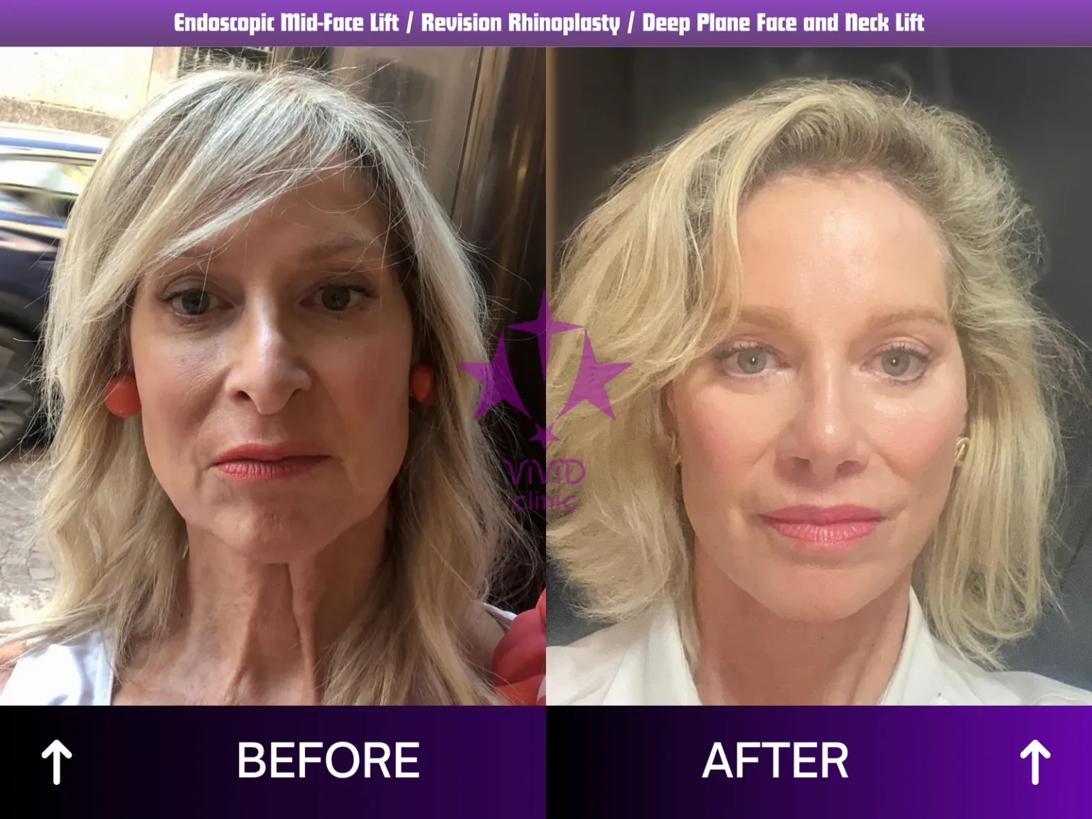 Frontal before and 9-month after comparison following endoscopic mid-face lift, revision rhinoplasty and deep plane face and neck lift