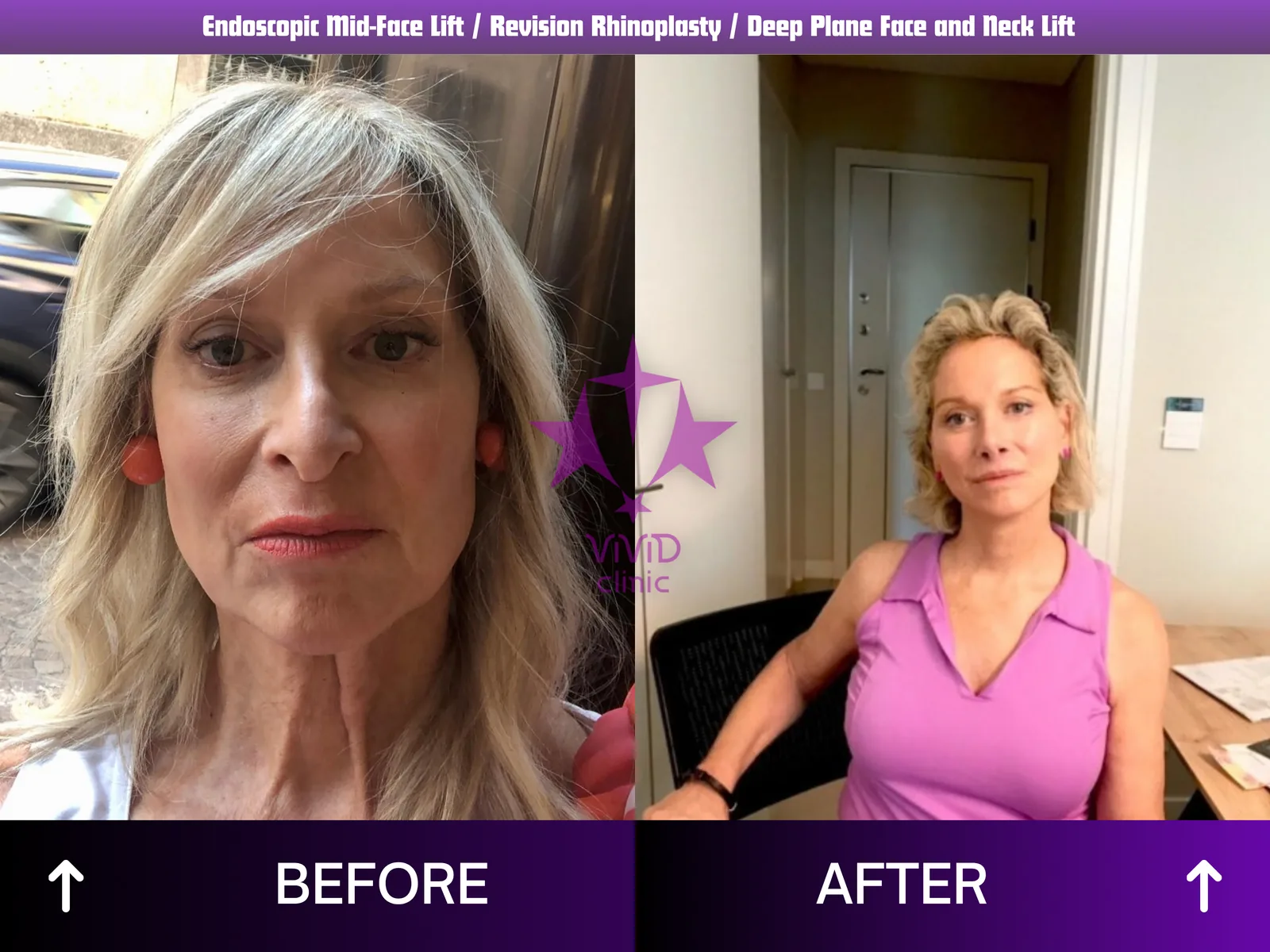 Revision Rhinoplasty Before and After: 9-Month Case Revision rhinoplasty before and after: wider frontal view at 9 months following endoscopic mid-face lift and deep plane face and neck lift