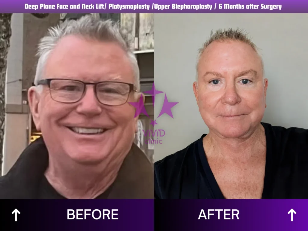 Male Facelift: 6-Month Results and Confident Planning Male facelift smiling before photo compared with neutral 6-month after photo, Vivid Clinic Istanbul