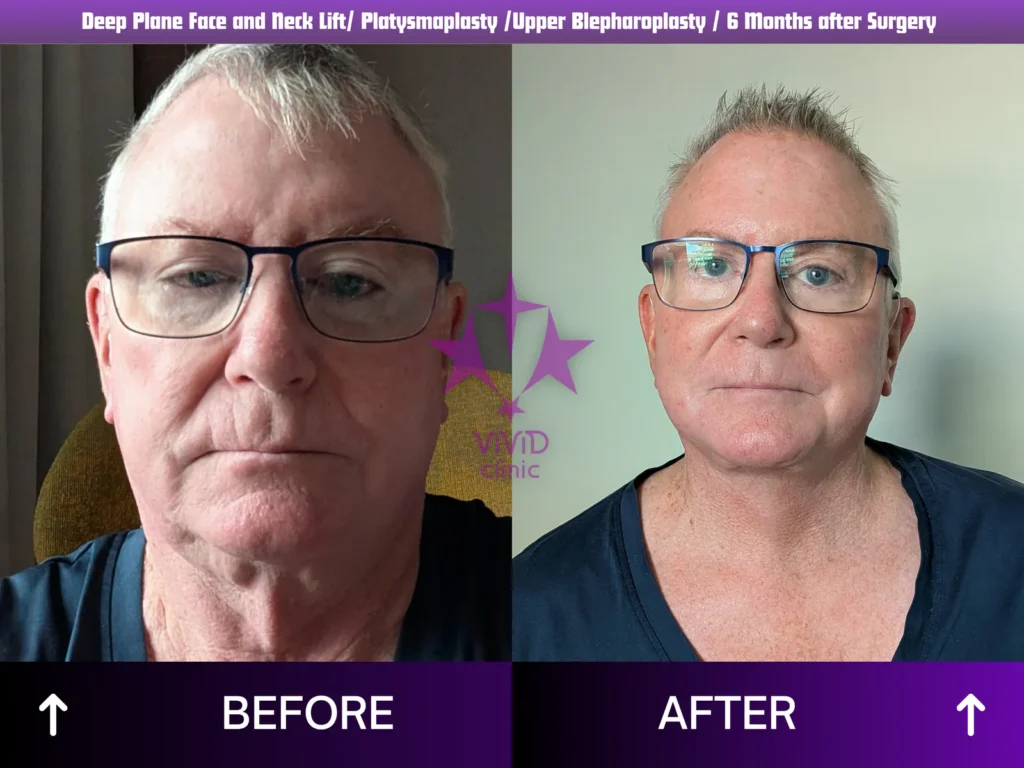 Male Facelift: 6-Month Results and Confident Planning Male facelift before and 6-month after frontal comparison, Vivid Clinic Istanbul
