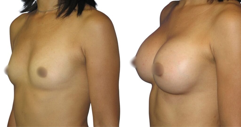 Fat Transfer Breast Augmentation Turkey: 8 Confidence-Boosting Insights Before Your Transformation breast augmentation before and after at Vivid Clinic Istanbul – Breast fat injections – Case 5