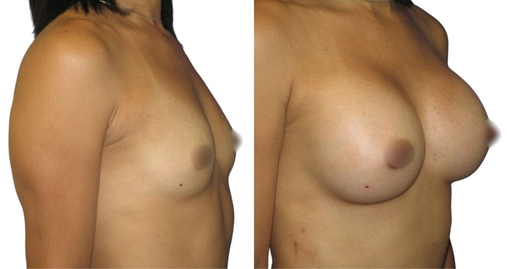 Fat Transfer Breast Augmentation Turkey: 8 Confidence-Boosting Insights Before Your Transformation breast augmentation before and after at Vivid Clinic Istanbul – Breast fat injections – Case 6