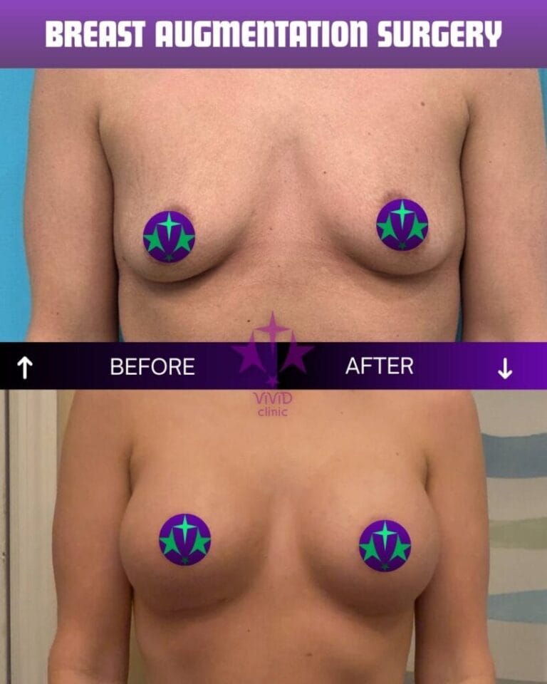 Breast augmentation before and after – related to breast reconstruction surgery at Vivid Clinic Istanbul, case 2