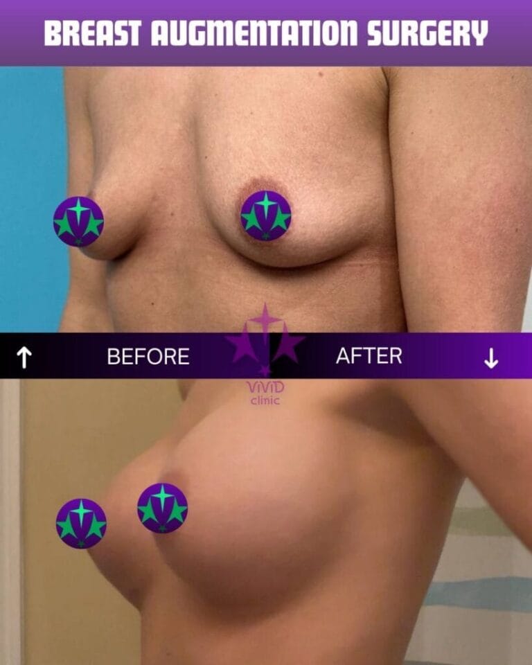 Breast augmentation before and after – related to breast reconstruction surgery at Vivid Clinic Istanbul, case 3
