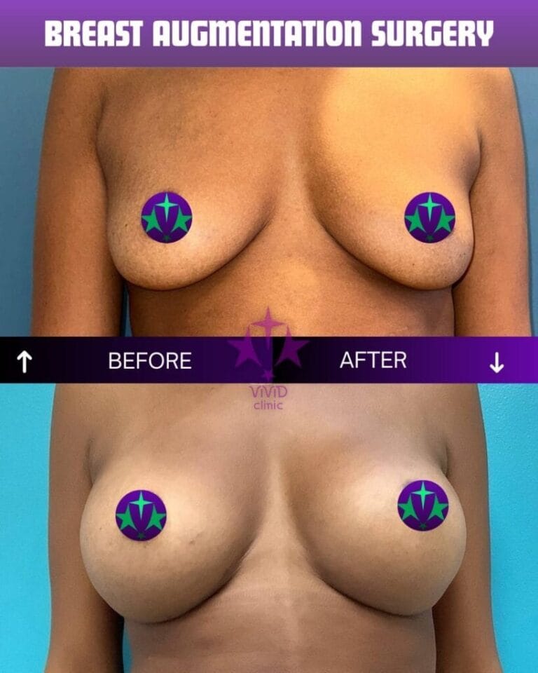 Breast augmentation before and after – related to breast reconstruction surgery at Vivid Clinic Istanbul, case 4