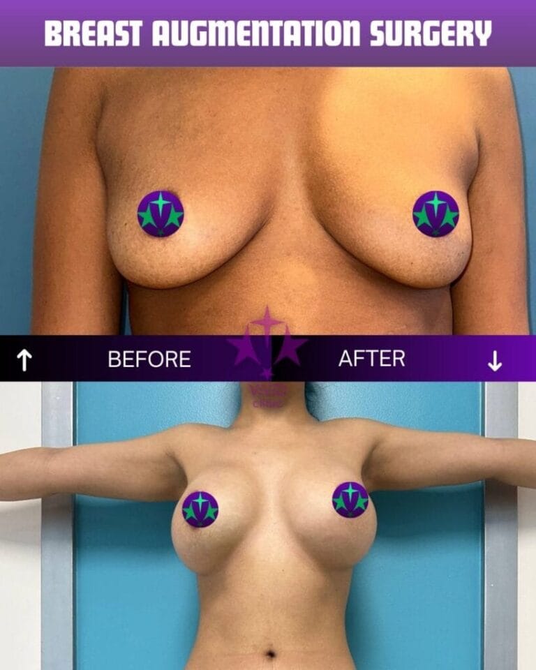 Breast augmentation before and after – related to breast reconstruction surgery at Vivid Clinic Istanbul, case 5