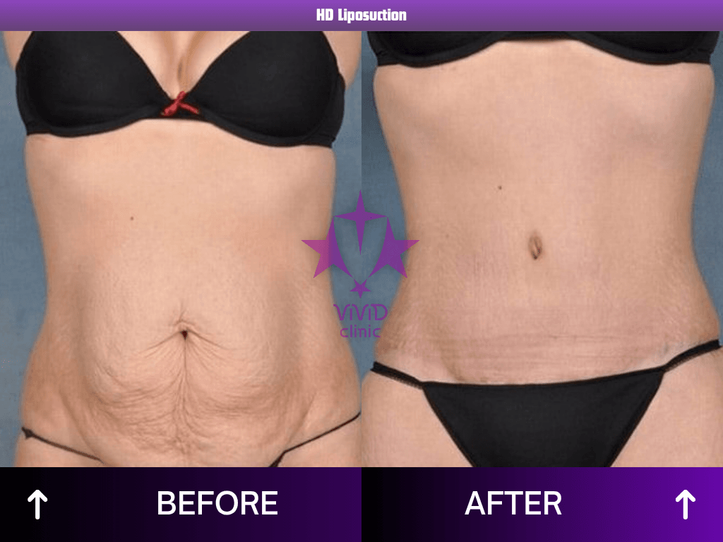 HD liposuction before and after, front: loose lower-abdominal skin before, flatter abdomen after