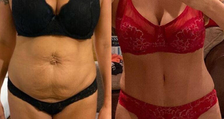 Liposuction before and after – body contouring alongside gastric balloon at Vivid Clinic Istanbul, case 7