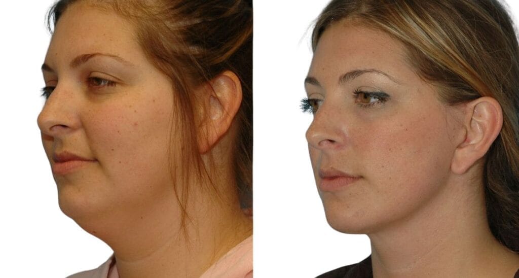Neck lift before and after, side profile: full submental area (double chin) before, defined jawline after