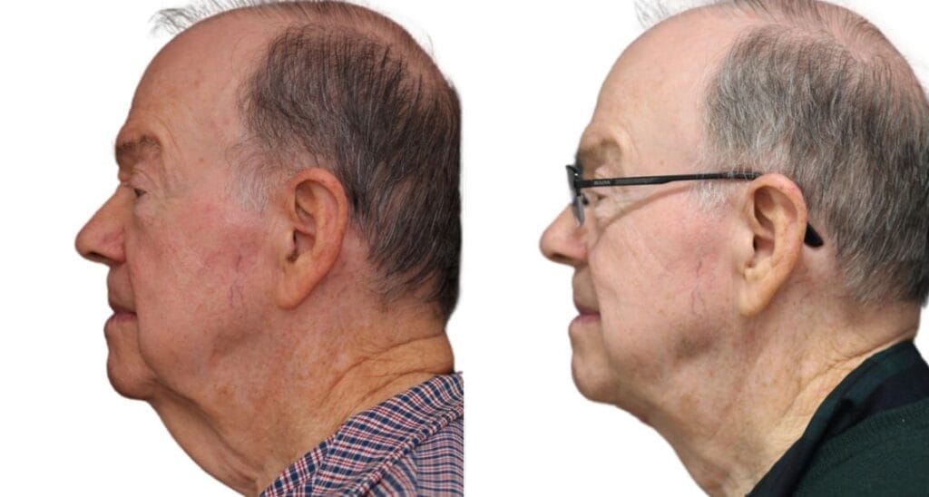 Neck lift before and after, side profile: loose neck skin (older male) before, smoother neck after