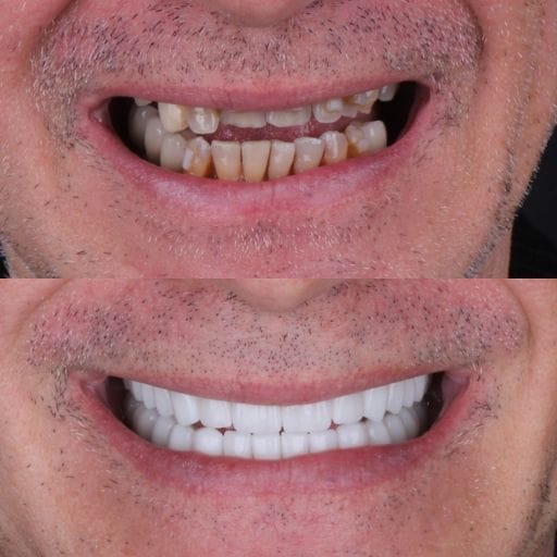 Transformación de la sonrisa antes y después, sonrisa frontal: dientes desgastados y descoloridos antes, sonrisa uniforme y brillante de arcada completa después
