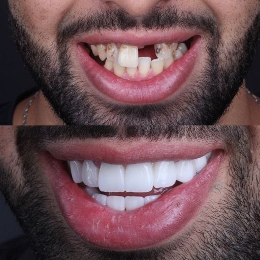 Veneers und Zahnkorrekturen bei Prominenten: Vorher und Nachher Zahnveneers vorher und nachher in der Vivid Clinic Istanbul – Patient 1