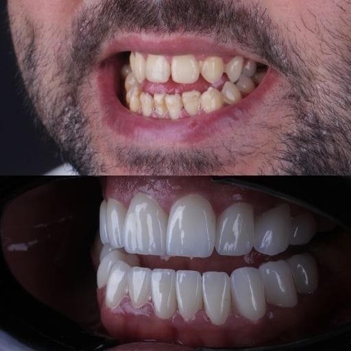 Veneers und Zahnkorrekturen bei Prominenten: Vorher und Nachher Zahnveneers vorher und nachher in der Vivid Clinic Istanbul – Patient 2