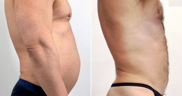 Tummy tuck before and after – body contouring alongside gastric balloon at Vivid Clinic Istanbul, case 4