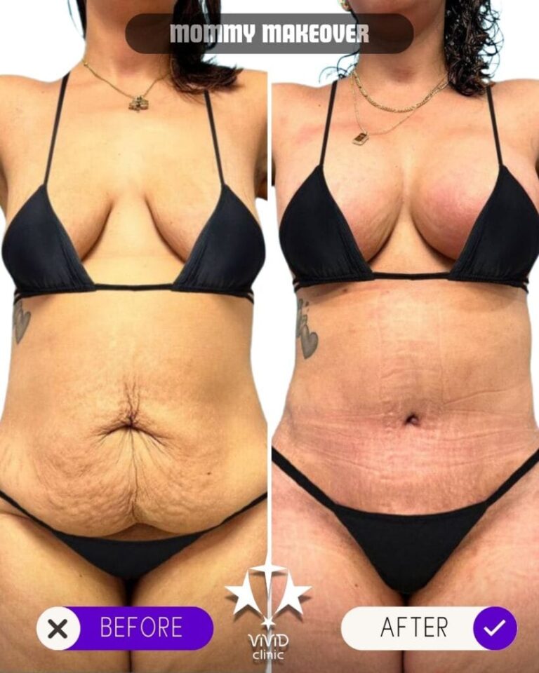 Tummy tuck before and after – body contouring alongside gastric botox at Vivid Clinic Istanbul, case 8