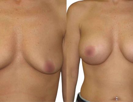 Before and After Breast Augmentation in Istanbul - Enhanced Shape