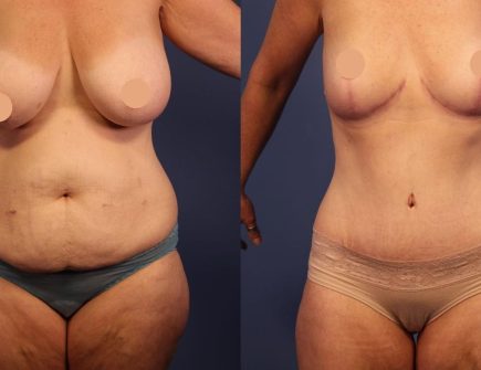 Before and after liposuction showing a patient with a slimmer waistline at Vivid Clinic