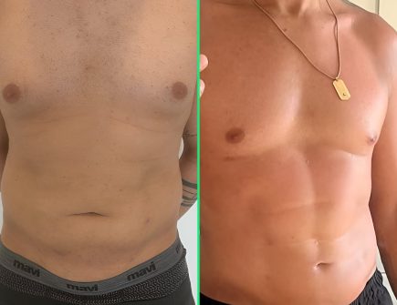 Defined six-pack abs and sculpted waist after six-pack surgery with HD liposuction at Vivid Clinic