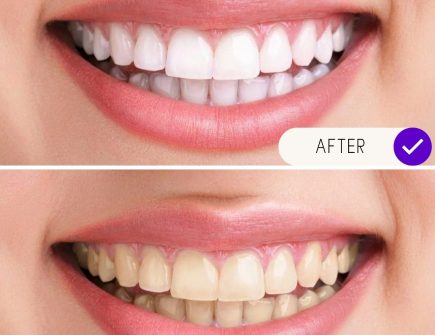 Full arch replacement with dental implants - before and after images.