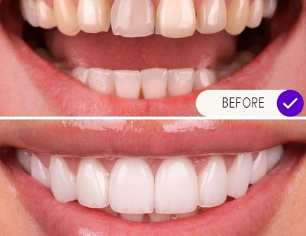 Before and after full mouth dental implants - functional and aesthetic improvements.