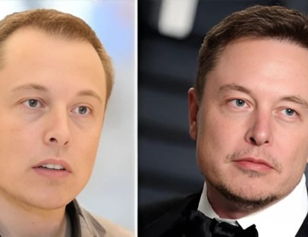 Doctor consulting with a patient before hair transplant surgery, similar to Elon Musk’s procedure.