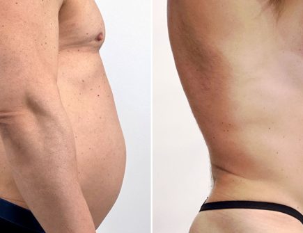 Best cosmetic surgery clinics in Istanbul showing before and after liposuction at Vivid Clinic