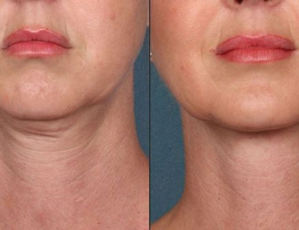 Neck Lift Before and After Results : Woman with visible signs of aging in the neck, including sagging skin and wrinkles.