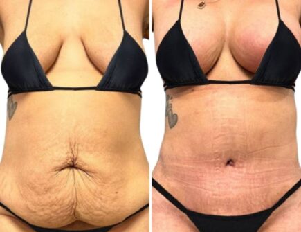 Before and after full-body mommy makeover results at Vivid Clinic in Istanbul
